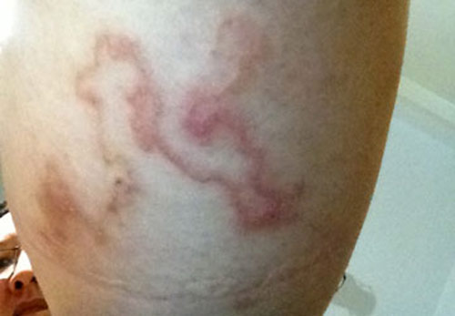 H&igrave;nh[-]ảnh[-]ấu[-]tr&ugrave;ng[-]giun[-]m&oacute;c[-]ch&oacute;,[-]m&egrave;o[-]chui[-]v&agrave;o[-]di[-]chuyển[-]dưới[-]da[-]người.[-]Ảnh:[-]ML